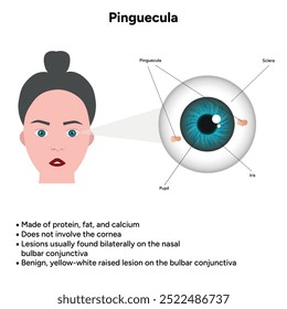 Oftalmologia. Informações pinguéculas e infográficas 