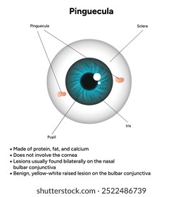 Oftalmologia. Informações pinguéculas e infográficas 