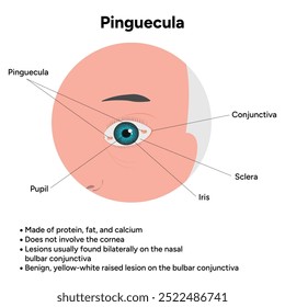 Oftalmologia. Informações pinguéculas e infográficas 