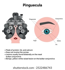 Oftalmologia. Informações pinguéculas e infográficas 