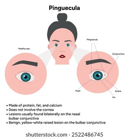 Oftalmologia. Informações pinguéculas e infográficas 