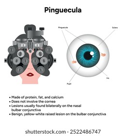 Oftalmologia. Informações pinguéculas e infográficas 