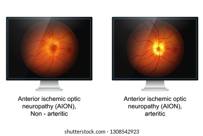 Optic ischemic neuropathy medical vector illustration