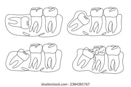 Options for placement of wisdom teeth. Incorrect tooth growth. Impacted tooth. One line drawing for different uses. Vector illustration.