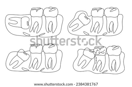 Options for placement of wisdom teeth. Incorrect tooth growth. Impacted tooth. One line drawing for different uses. Vector illustration.
