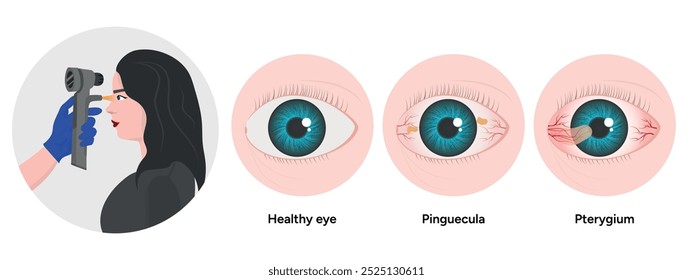Cita de optometría para pinguécula ocular sana y pterigión