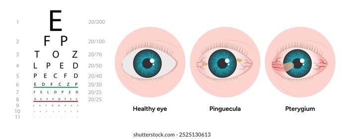 Indicação de optometria pinguécula e pterígio do olho saudável