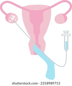 Ilustración vectorial Ovum Pick Up de OPU. Perfecto para presentar cualquier cosa sobre reproducción, inseminación o ivf.
