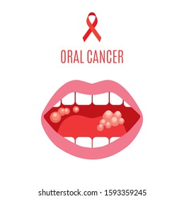 Oral cancer.  Anatomical vector drawing. Ribbon.