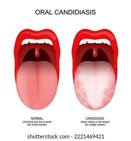 candidiasis oral. diferencia y comparación de boca y lengua sanas con infección fúngica. 