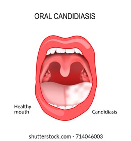 Oral candidiasis. oral thrush. healthy mouth and tongue with candidiasis infection