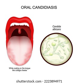 orale Candididiasis. Infektion mit Mundsockeln. Weiße Beschichtung auf der Zunge wie Hüttenkäse. Nahaufnahme eines Pilzes Candida albicans. Vektorgrafik