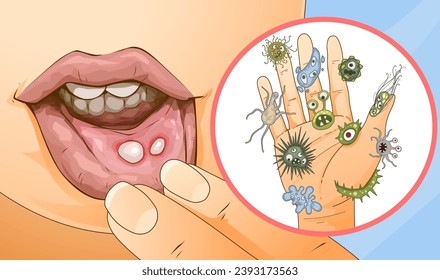 Orale Erkrankung. Stomatitis. Ursachen der Stomatitis. Infektion an schmutzigen Händen. Illustration im Gesundheitswesen. Vektorgrafik.