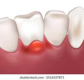 Gengivite oral. Doença gengival ou inflamação gengival por gengivite. Doença periodontal. Fluxo dentário