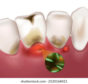 Gengivite oral. Doença gengival ou inflamação gengival por gengivite. Doença periodontal. Fluxo dentário