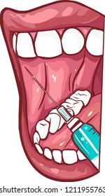 Oral And Maxillofacial Regional Anesthesia