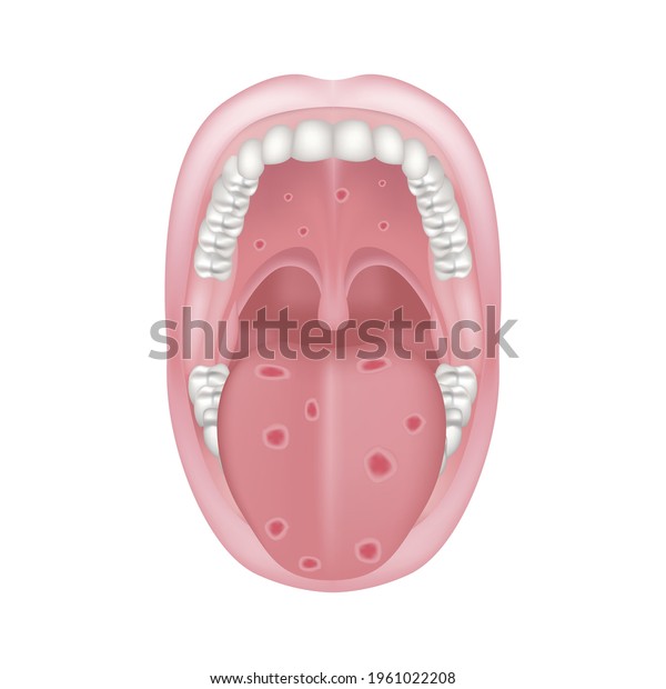 Oral Syphilis Venereal Disease Ulcers On Stock Vector (Royalty Free ...