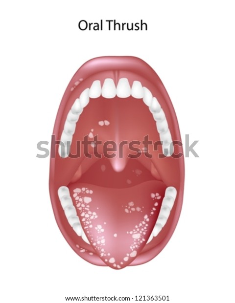 Oral Thrush Candidiasis Stock Vector (Royalty Free) 121363501