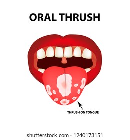Oral thrush. Candidiasis on the tongue. Fungus in the mouth. Infographics. Vector illustration on isolated background.