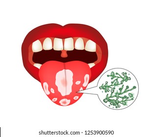 Oral thrush. Candidiasis on the tongue. Fungus in the mouth. Infographics. Vector illustration on isolated background.