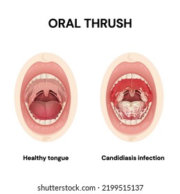 Oral Thrush. Candidiasis. Symptoms.Candida Infections Of The Mouth. Oropharyngeal Candidiasis.Vector. 