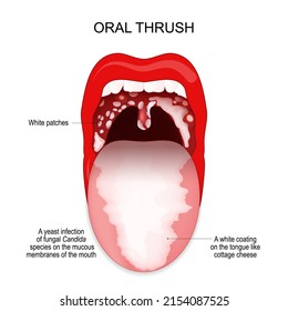 562 Candidiasis mouth Images, Stock Photos & Vectors | Shutterstock