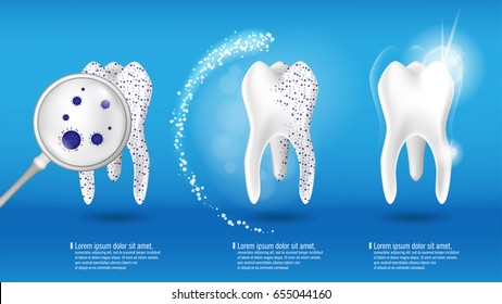 Oral tooth care concept. Set of clean and dirty tooth on blue background with clearing tooth process. Realistic 3d Vector illustration. For your design, advertising, stomatology poster, flyer