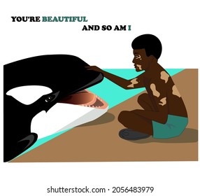 Niño orca y africano con pigmentación blanca. Día Mundial del Vitiligo. Amor propio. Enfermedad cutánea. Cuerpo positivo.