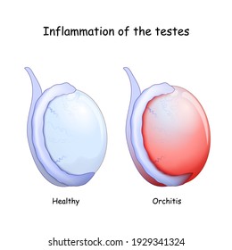 Orchitis is inflammation of the testes. comparison and difference of Healthy testicle and testicle with infection. Signs and symptoms of the disease