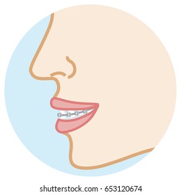 Orthodontic appliance -Face close-up, Side view