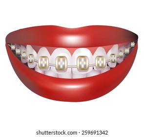 Orthodontic braces. 