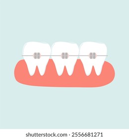 Orthodontic Braces Metal Conventional Illustration