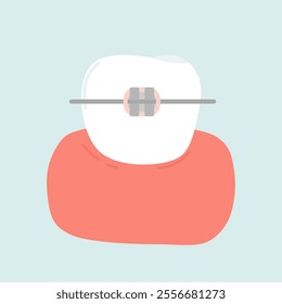 Orthodontic Braces Metal Conventional Illustration