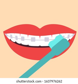 Orthodontic braces on teeth. Tooth brushing. Vector illustration