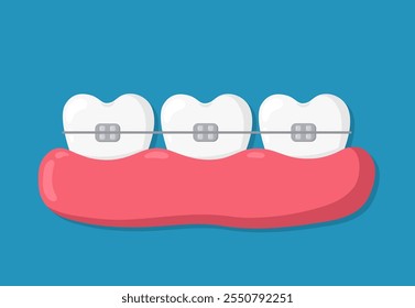 Correção ortodôntica de mordida com conceito de aparelho. Dentes lisos brancos na gengiva com aparelho instalado. Cuidados dentários e design de tratamento. Ilustração plana vetorial isolada no plano de fundo azul