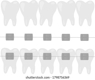 Orthodontic set of jaws with teeth with braces vector illustration