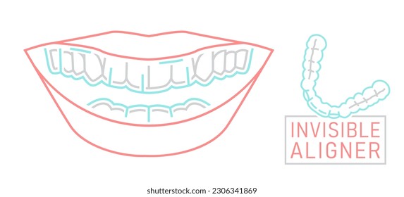 Orthodontic silicone trainer. Invisible braces aligner, retainer. Medical scheme. Outside view. Healthy smile. Horizontal poster. Editable vector illustration isolated on a white background.
