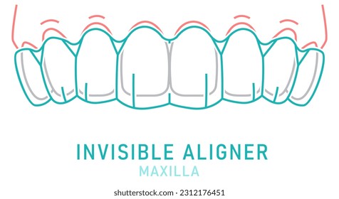 Orthodontic silicone trainer. Invisible braces aligner, retainer. Medical scheme. Inside view. Upper jaw. Horizontal poster. Editable vector illustration isolated on a white background.