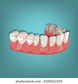 Entrenador de silicona ortodoncia. Alteración de llaves invisibles, fiador. Dibujo médico al estilo de las caricaturas. Vista exterior. Bajo la mandíbula. Mandibula. Ilustración vectorial editable aislada en un fondo azul.