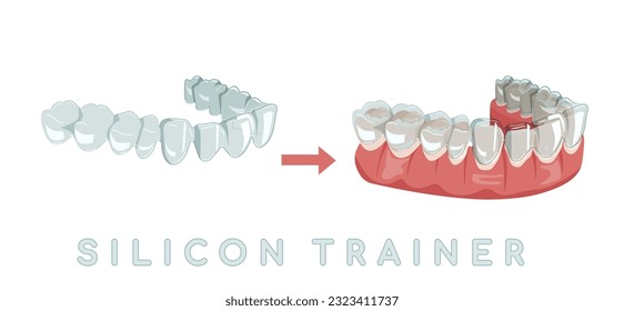 Orthodontic silicone trainer. Invisible braces aligner, retainer. Medical drawing in cartoon style. Outside view. Under jaw. Mandibula. Editable vector illustration isolated on a blue background.