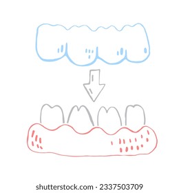 Orthodontic silicone trainer. Invisible braces aligner, retainer. Medical drawing in hand drawn doodle style. Lower jaw. Editable vector illustration isolated on a white background.