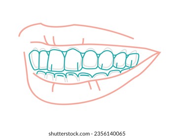 Entrenador de silicona ortodoncia. Alteración de llaves invisibles, fiador. Sonrisa saludable. Debajo, mandíbula superior. Mandibula, Maxilla. Afiche médico horizontal. Ilustración vectorial editable en un fondo blanco.