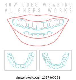 Orthodontic silicone trainer. Invisible braces aligner poster. Medical banner in outline style. Outside, inside view. Upper, lower jaw. Editable vector illustration on a white background
