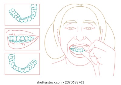 Orthodontic silicone trainer. Invisible braces aligner poster. Hand holding aligner. Medical banner in outline style. Outside, view. Upper jaw. Editable vector illustration on a dark blue background