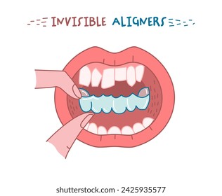 Orthodontic silicone trainer. Invisible braces retainer. Medical concept. Hand holding aligner. Under jaw. Horizontal poster. Editable vector illustration isolated on a white background.