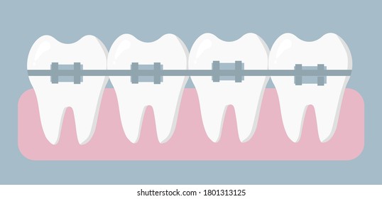 Orthodontic treatment. Braces on your teeth. Concept of dentistry and medicine. Vector illustration in a flat design.