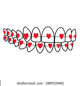 Orthodontic treatment braces system on teeth from hearts u dentistry logo.orthodontist day Vector Illustration.  Poster for dentist, orthodontist. Result after using bracket system. 