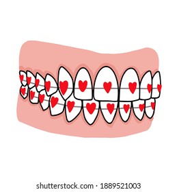 Orthodontic Treatment Braces System On Teeth From Hearts U Dentistry Logo. Orthodontist Day Vector Illustration.  Poster For Dentist, Orthodontist. Result After Using Bracket System. 