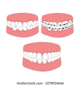 Orthodontic treatment of malocclusion of the teeth braces. Vector illustration for booklets, flyers, brochures, dental clinic website.