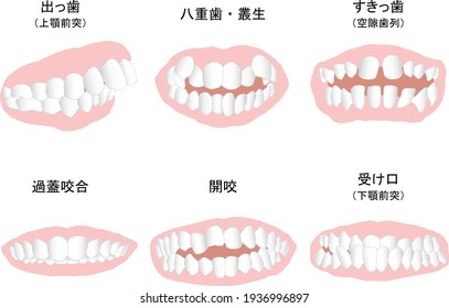 Orthodontic treatment No symptom line Colored. meaning is "protruding teeth(Maxillary　prognath)","cuspid","sukippa(Void dentition)","Overcapsular occlusion","Open bite","Protruding chin"